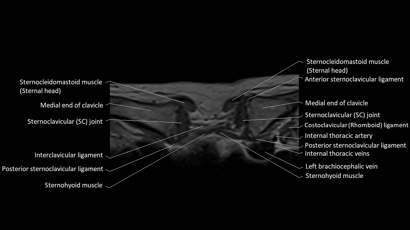 MRI sternum and sternoclavicular joint labeled axial anatomy image 3.webp
